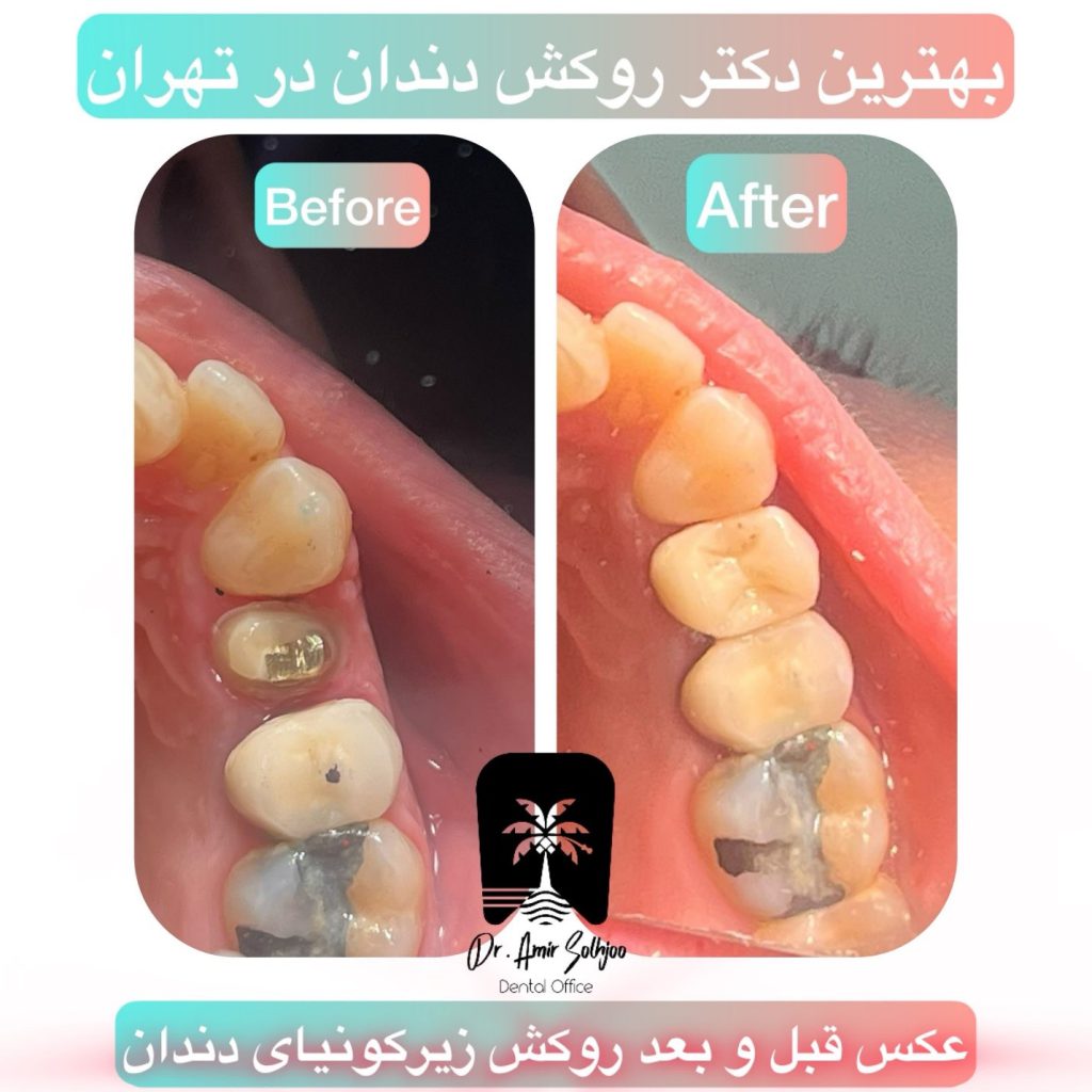 روکش دندان