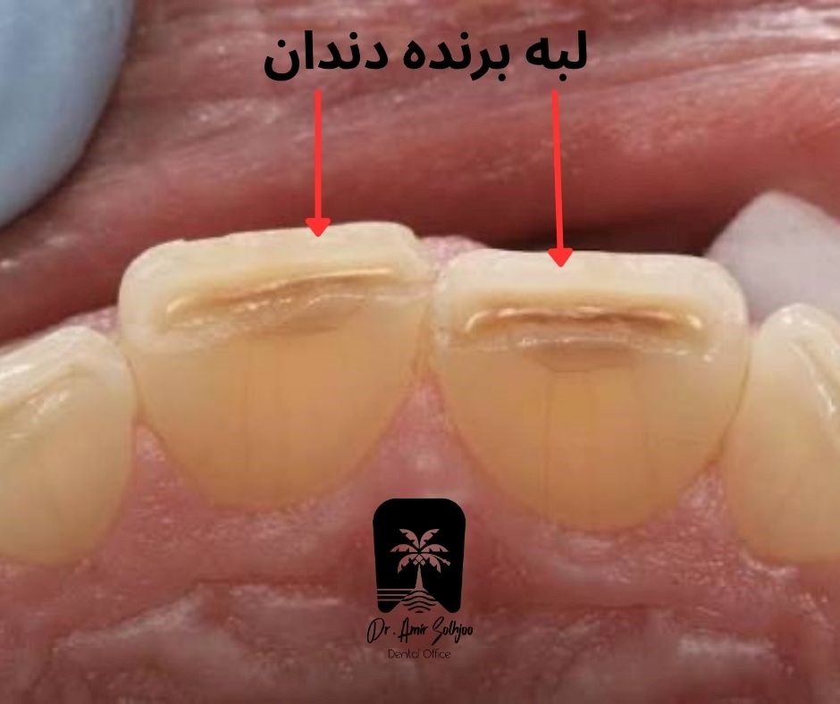 لبه برنده دندان