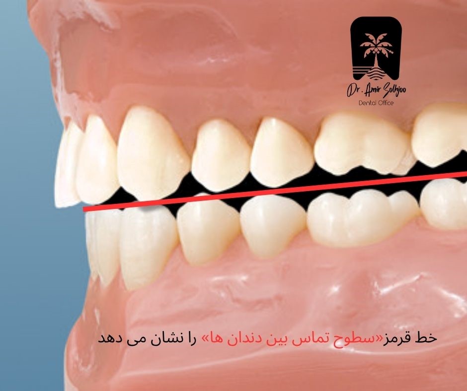 سطوح تماس بین دندانها