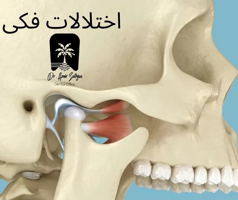 اختلالات فکی