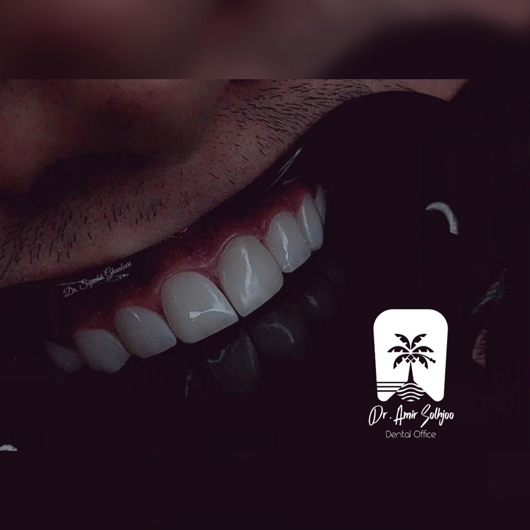 هزینه پر کردن دندان