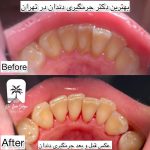 بهترین جرمگیری دندان