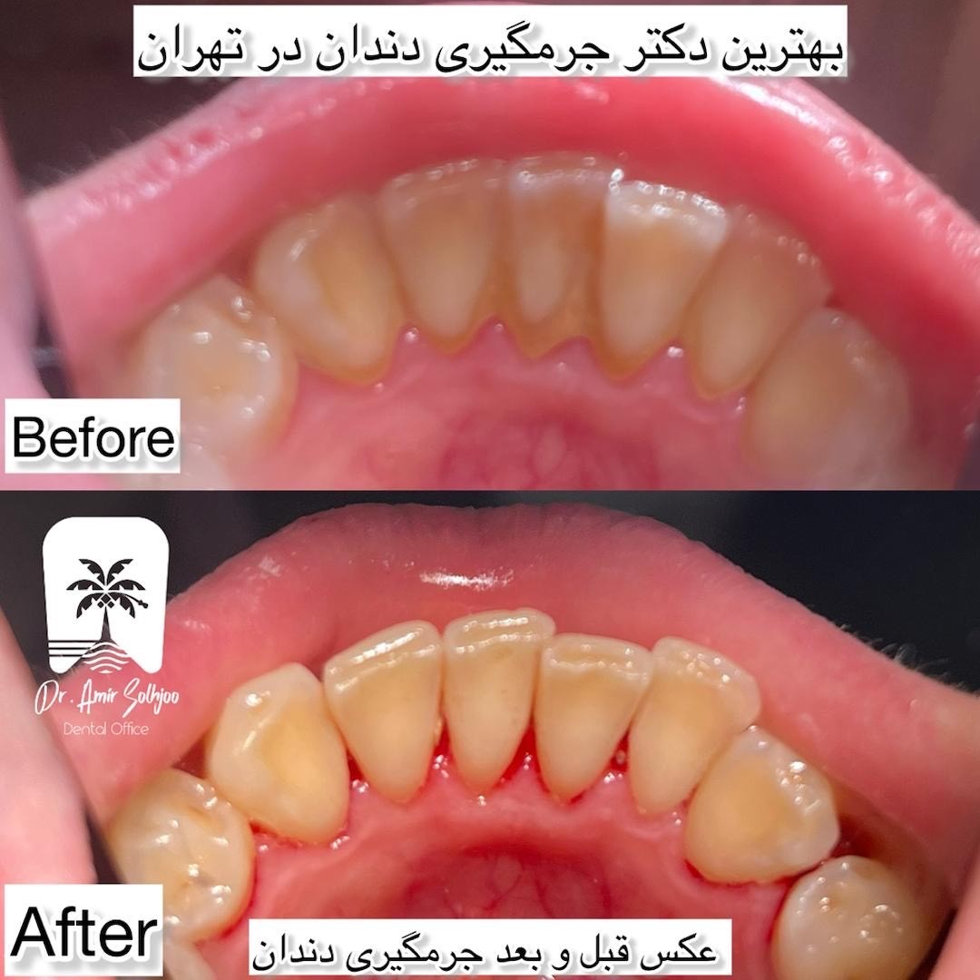 بهترین جرمگیری دندان