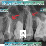 بهترین مرکز عصب کشی دندان در صادقیه و آریاشهر تهران