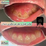 هزینه جرم گیری دندان