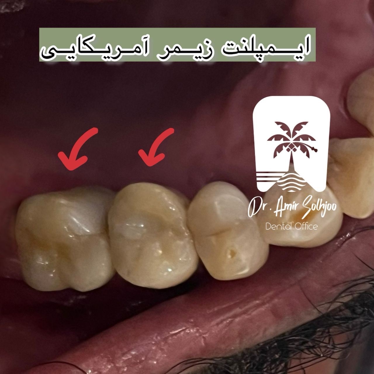 کاشت ایمپلنت دندان در سعادت آباد