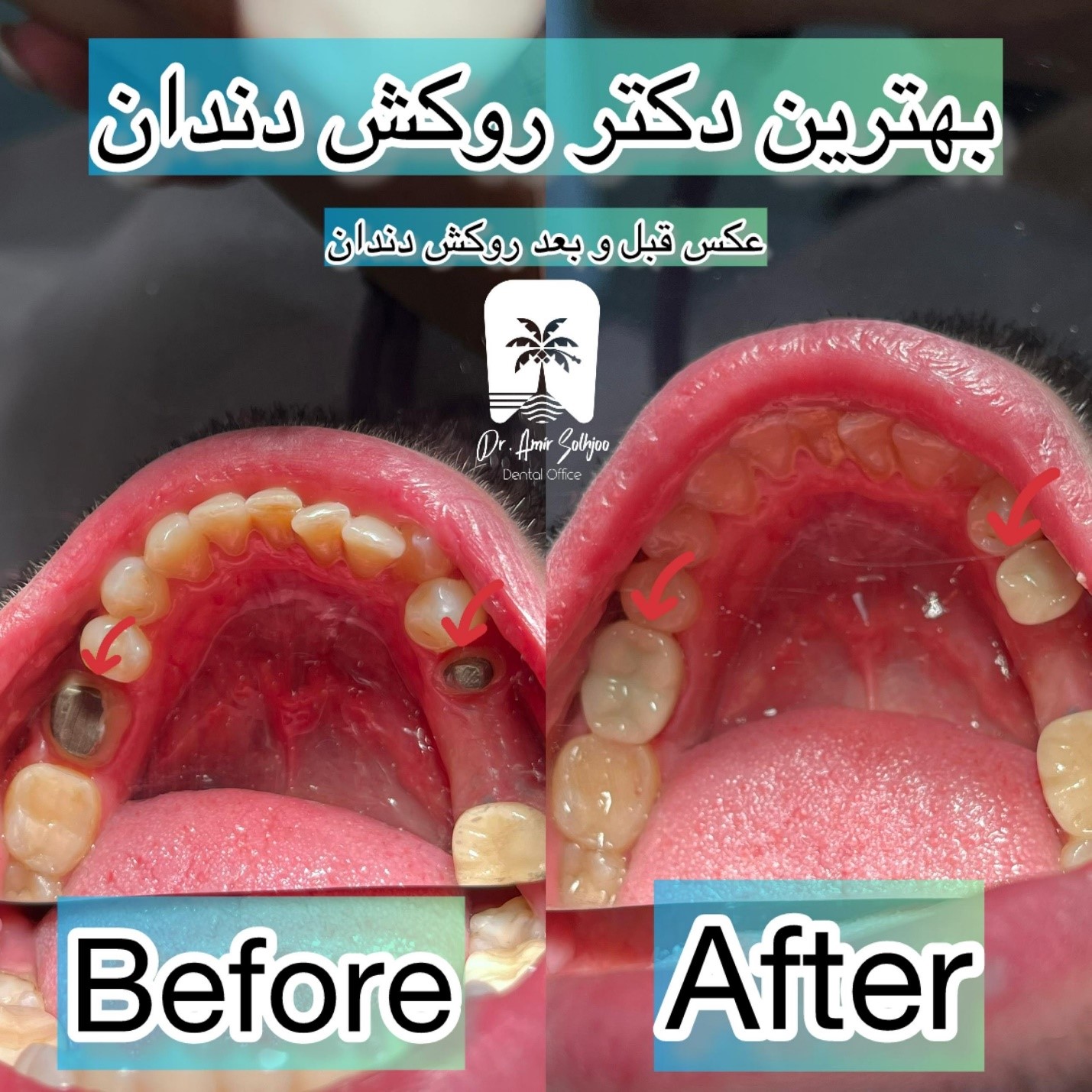 هزینه روکش دندان