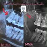 هزینه کشیدن دندان عقل در مطب خصوصی