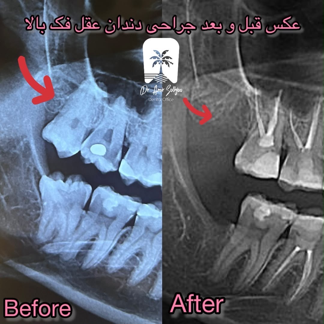 هزینه کشیدن دندان عقل در مطب خصوصی