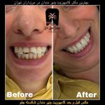 لیست قیمت پرکردن دندان
