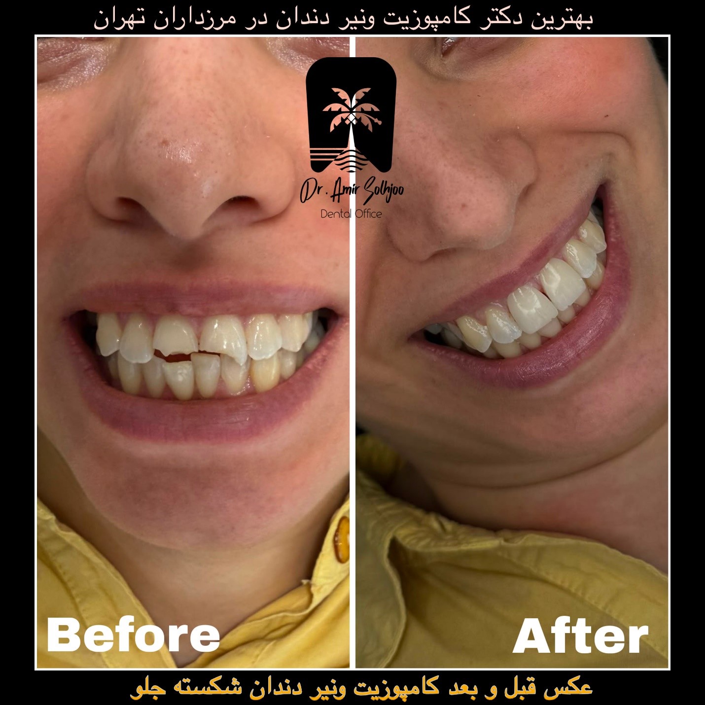 لیست قیمت پرکردن دندان