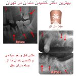 قیمت کشیدن دندان آزاد