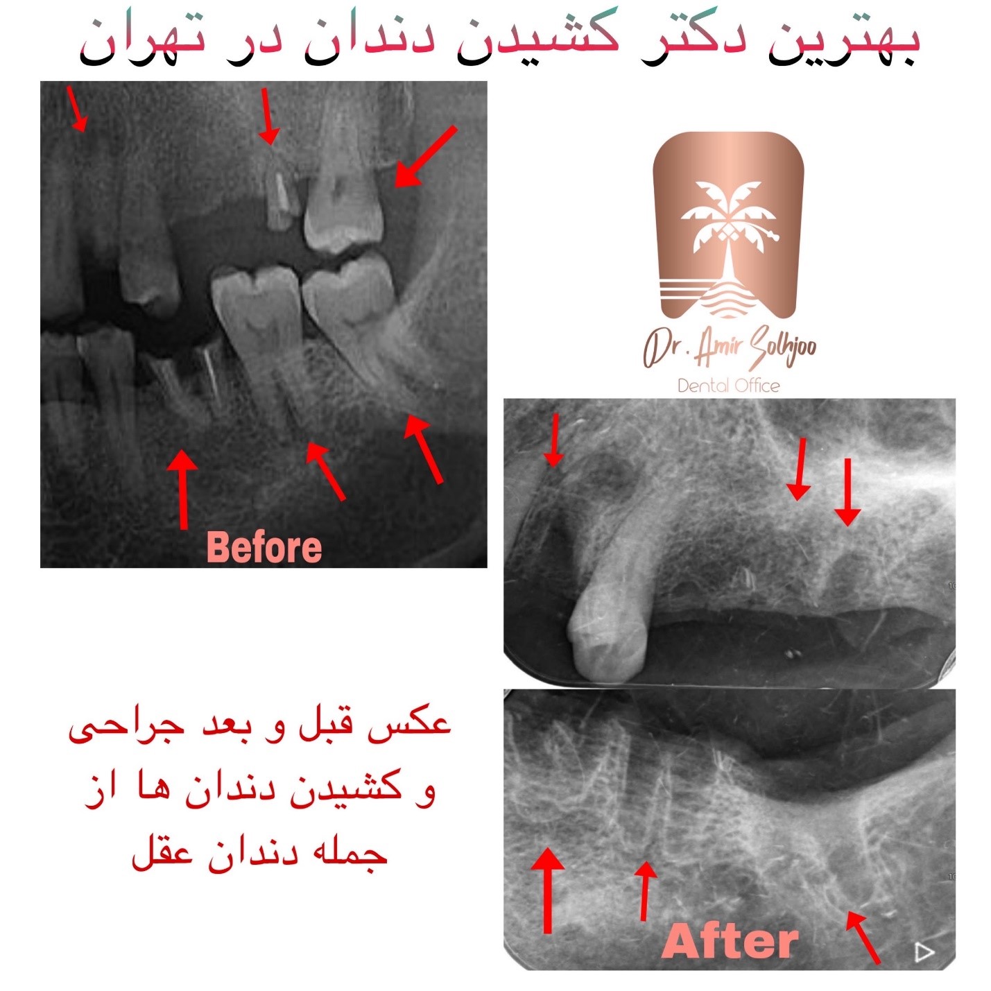 قیمت کشیدن دندان آزاد
