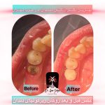 هزینه روکش زیرکونیا