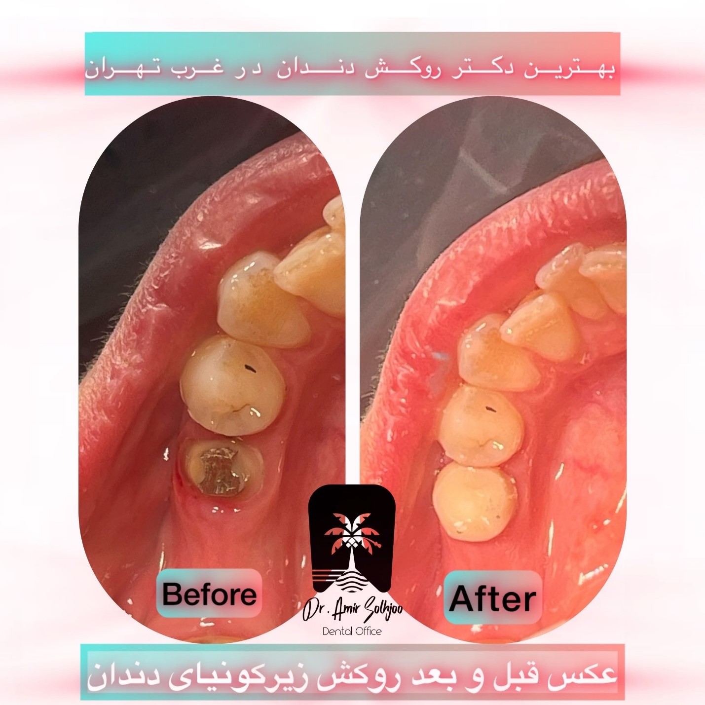هزینه روکش زیرکونیا