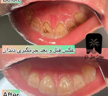 هزینه جرم گیری دندان