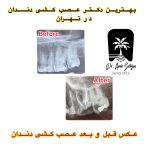 هزینه عصب کشی دندان