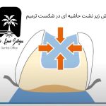 نقش ریزنشت حاشیه‌ای در شکست ترمیم