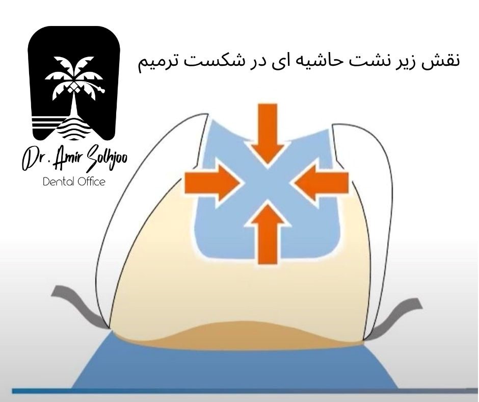 نقش ریزنشت حاشیهای در شکست ترمیم