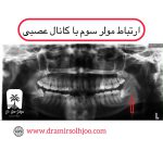 ارتباط مولر سوم با کانال عصبی