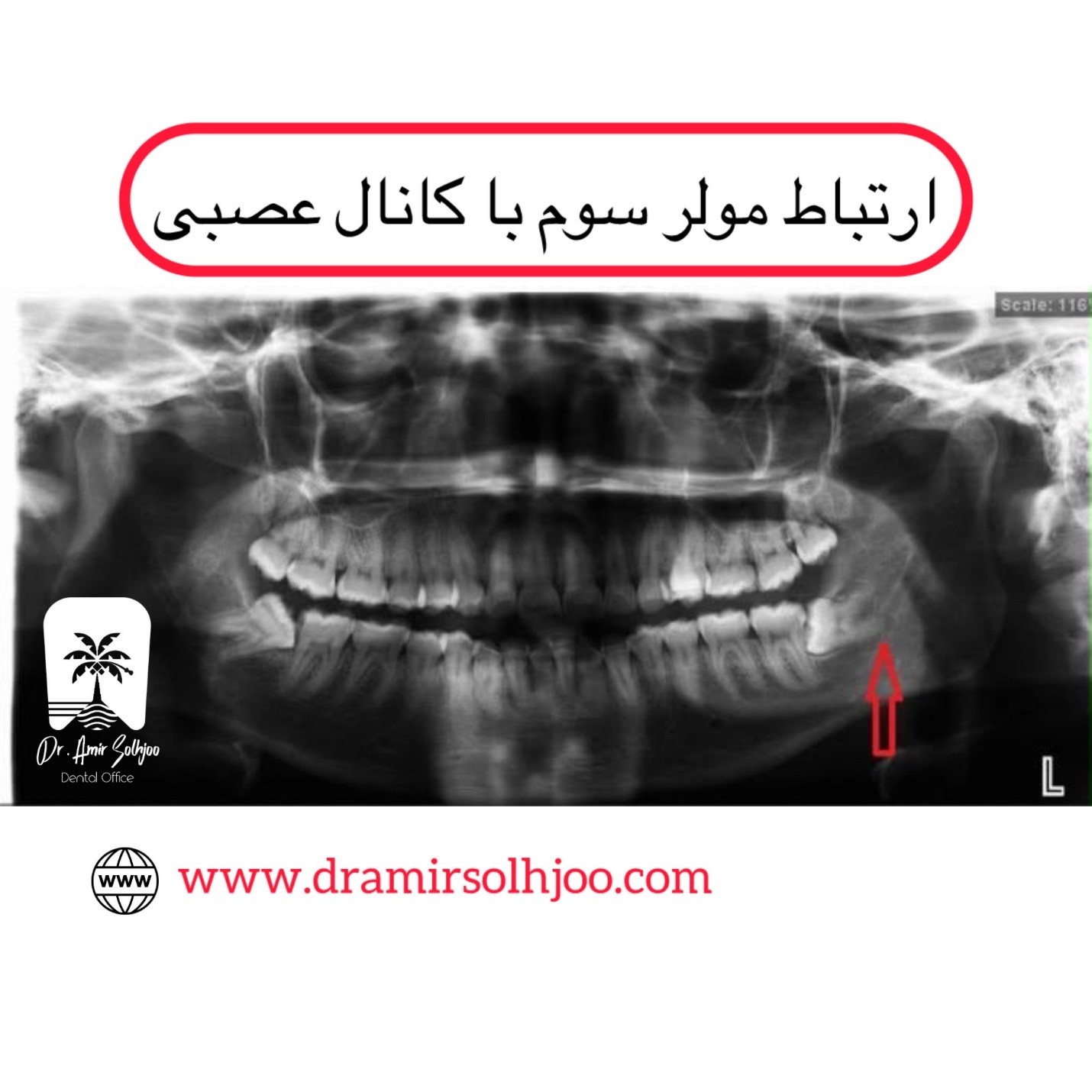 ارتباط مولر سوم با کانال عصبی