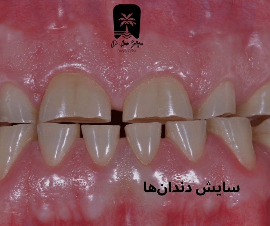 سایش دندان
