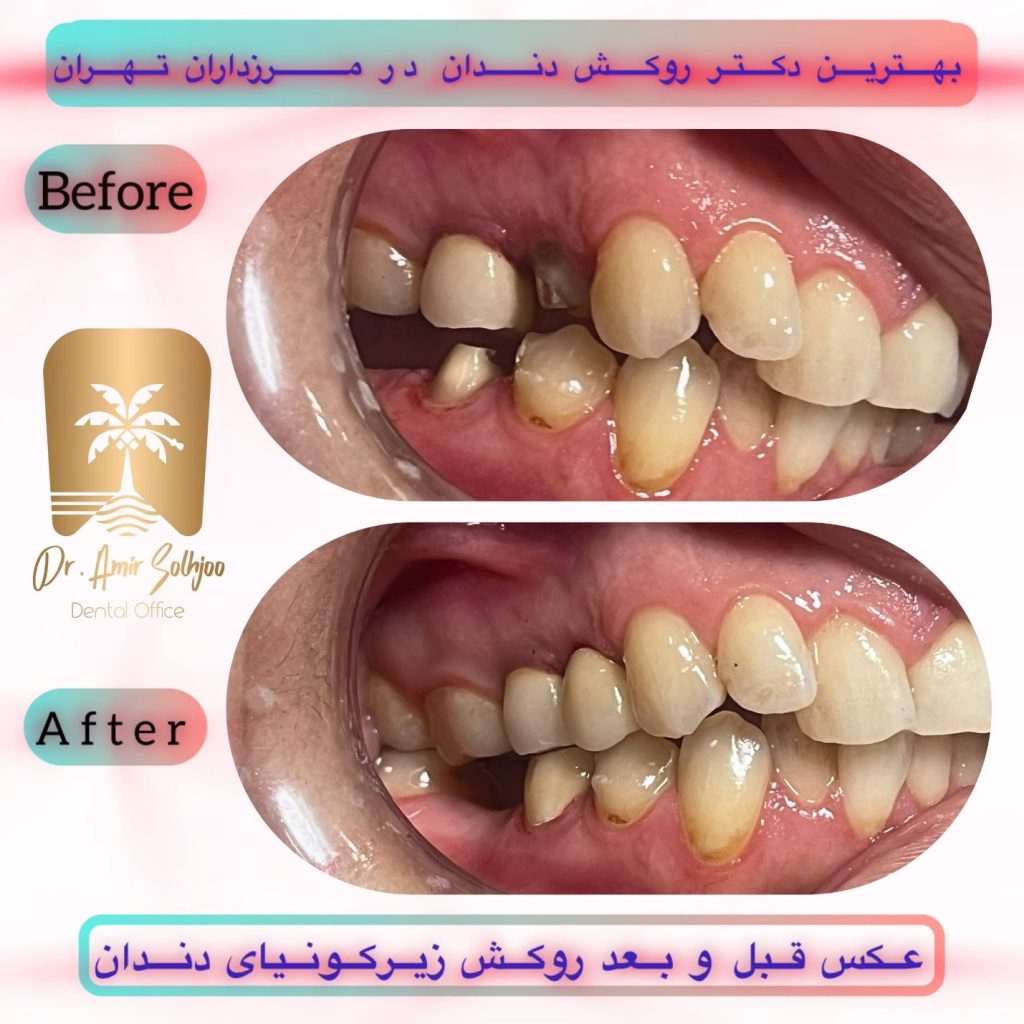 هزینه روکش زیرکونیا