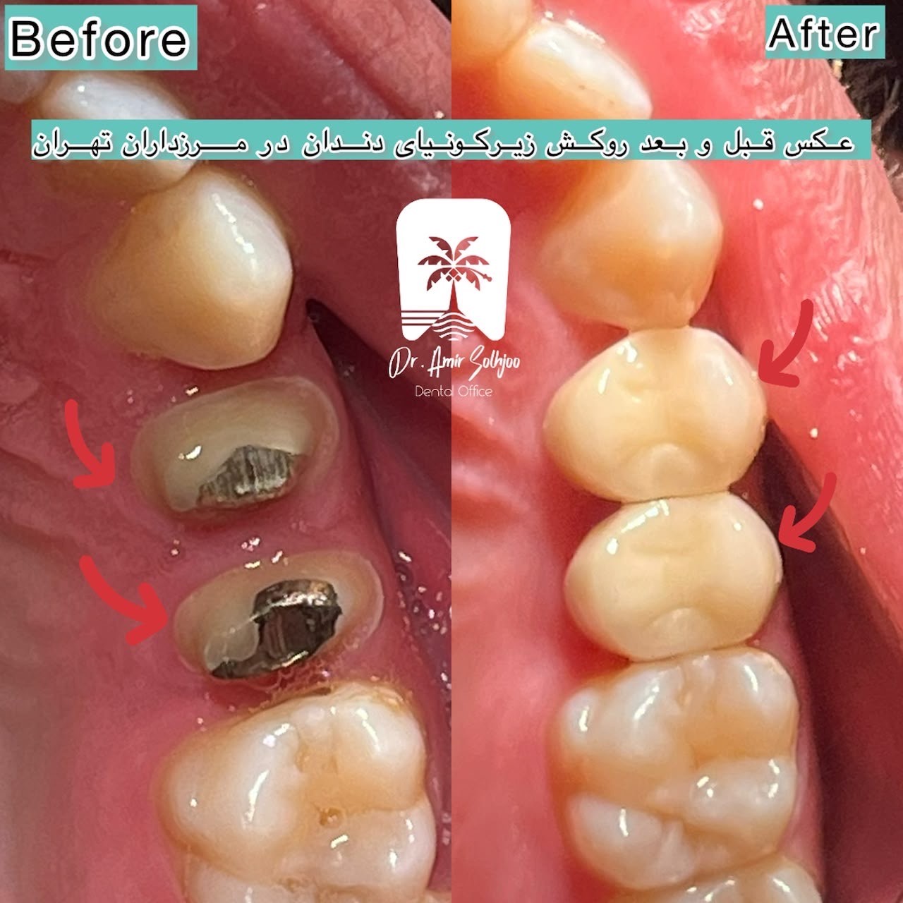 بهترین روکش برای دندان آسیاب
