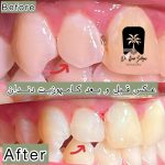 قیمت پر کردن دندان با مواد سفید