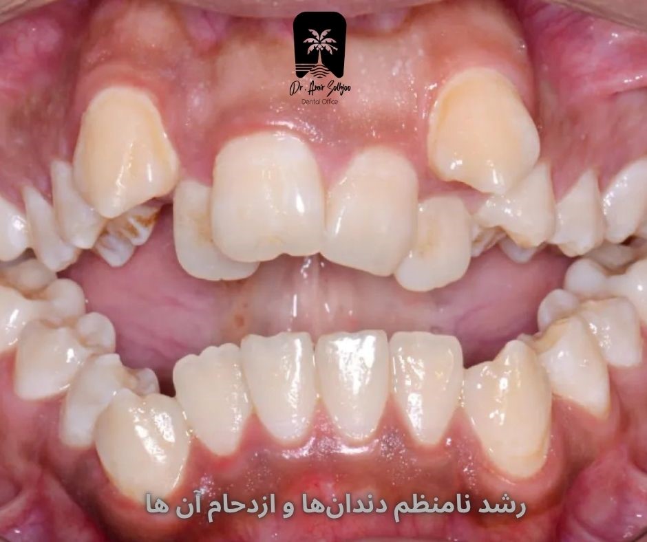 رشد نامنظم دندانها و ازدحام آن ها