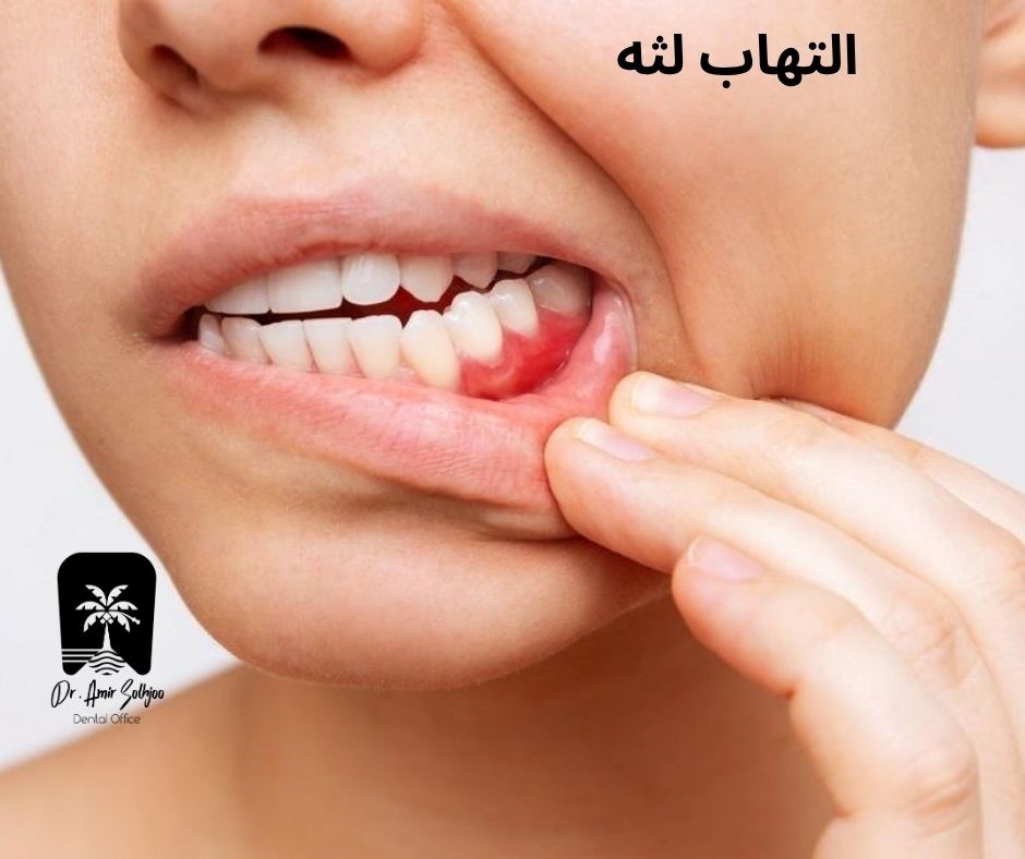 التهاب لثه