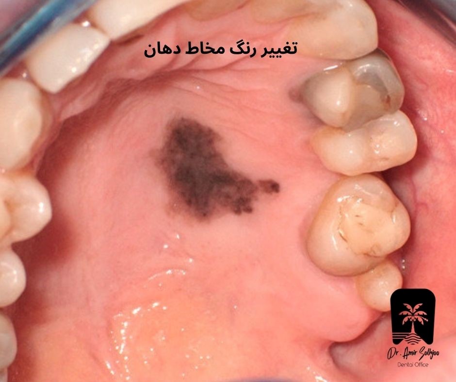 تغییر رنگ مخاط دهان
