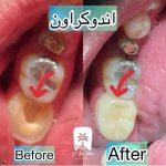 قیمت پر کردن دندان با سرامیک
