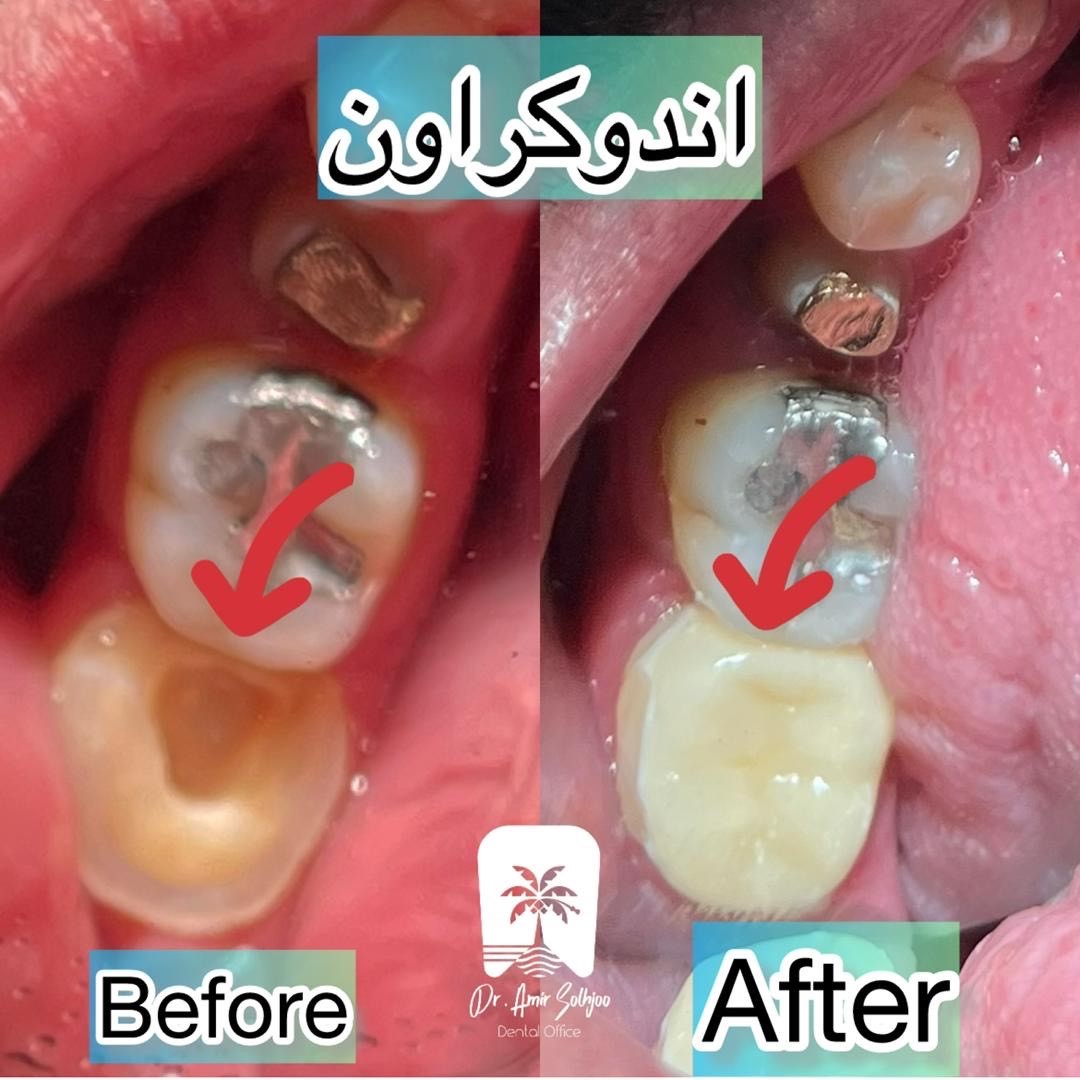 قیمت پر کردن دندان با سرامیک