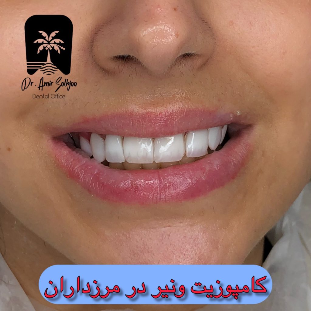 هزینه پر کردن دندان