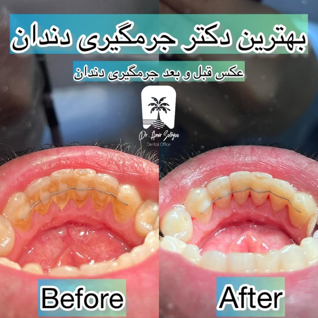 بهترین جرمگیری دندان