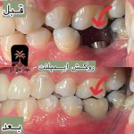 کاشت ایمپلنت دندان در سعادت آباد