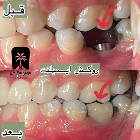 کاشت ایمپلنت دندان در سعادت آباد