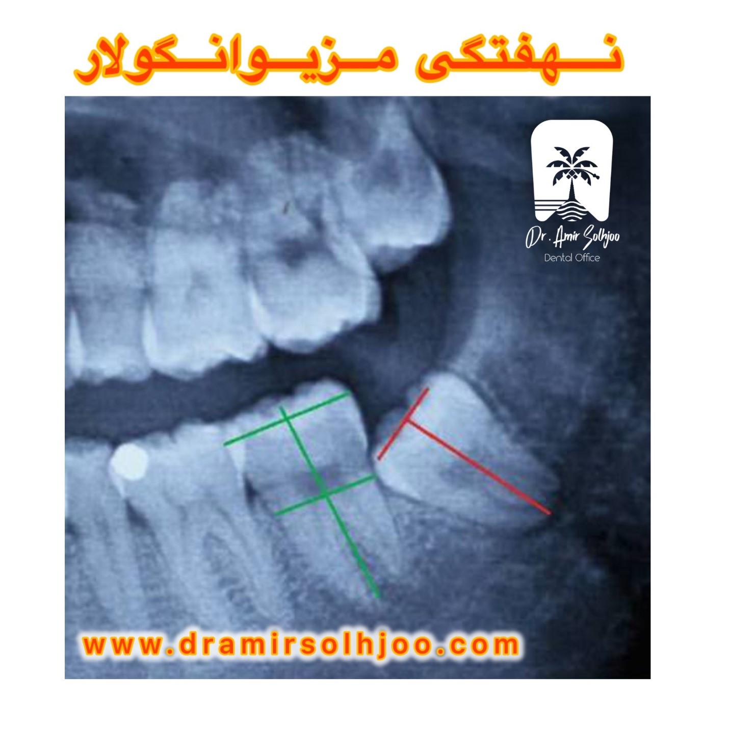 نهفتگی مزیوانگولار دندان عقل