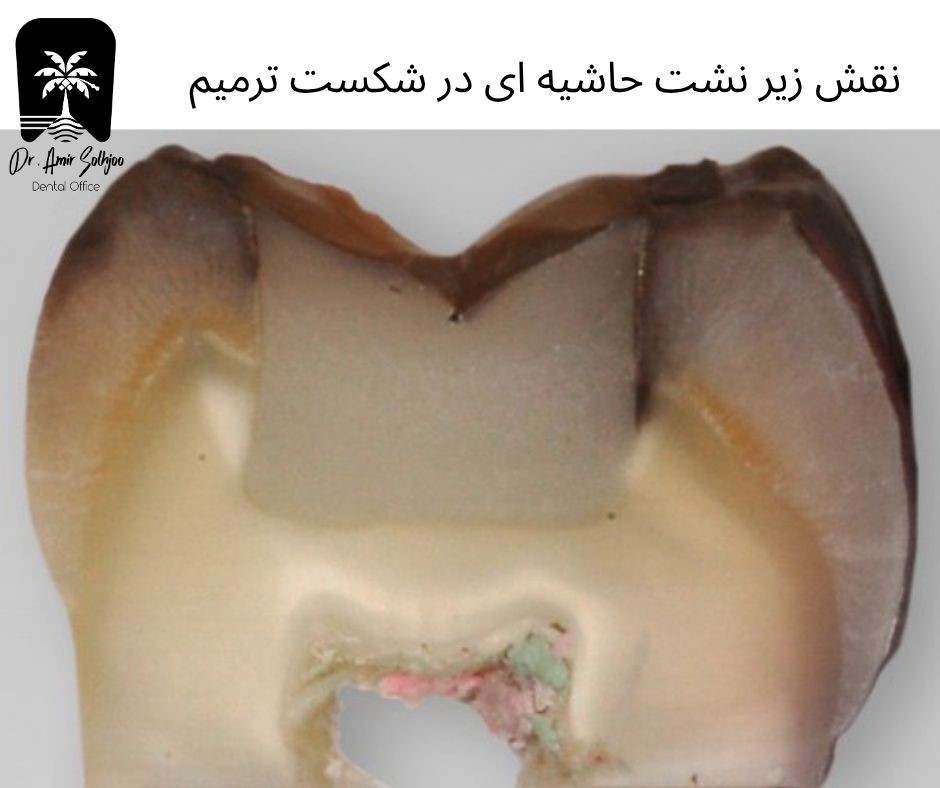 نقش ریزنشت حاشیهای در شکست ترمیم