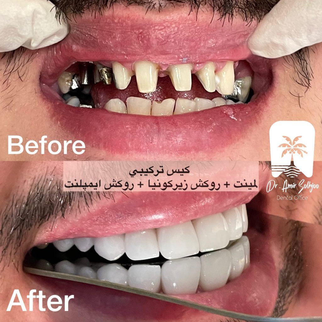 هزینه لمینت دندان