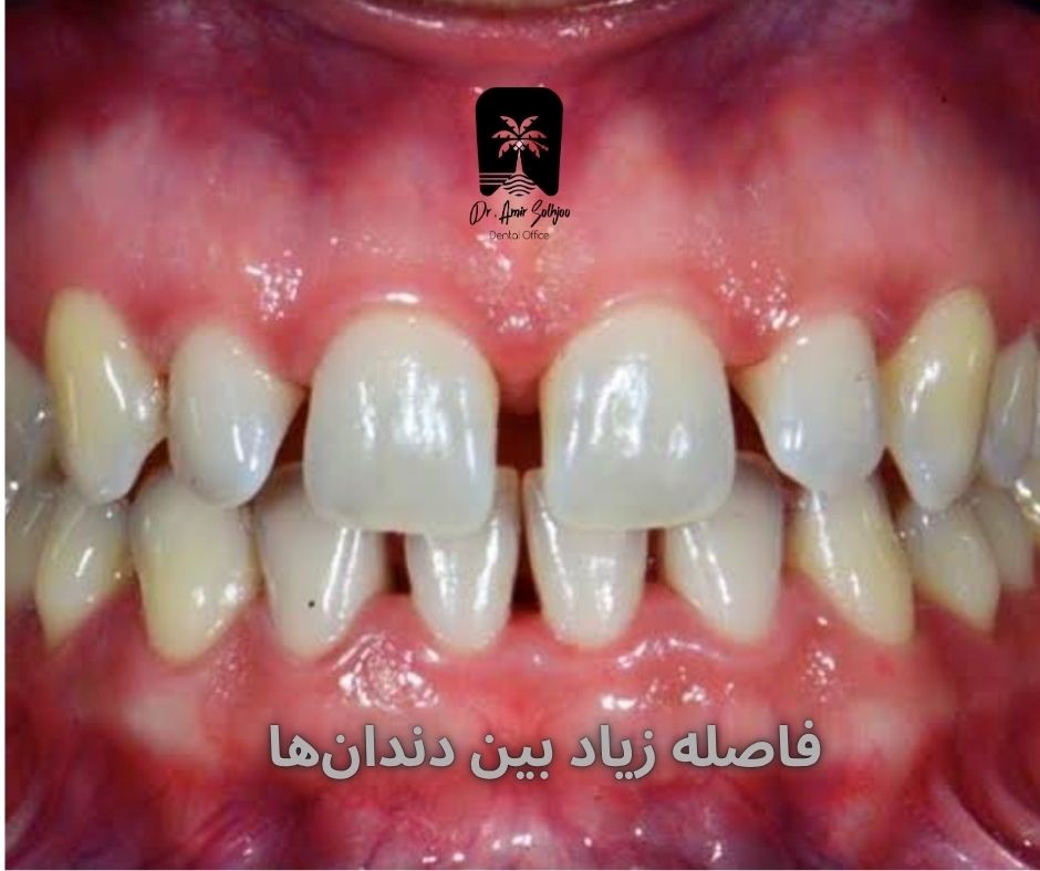 فاصله زیاد بین دندانها