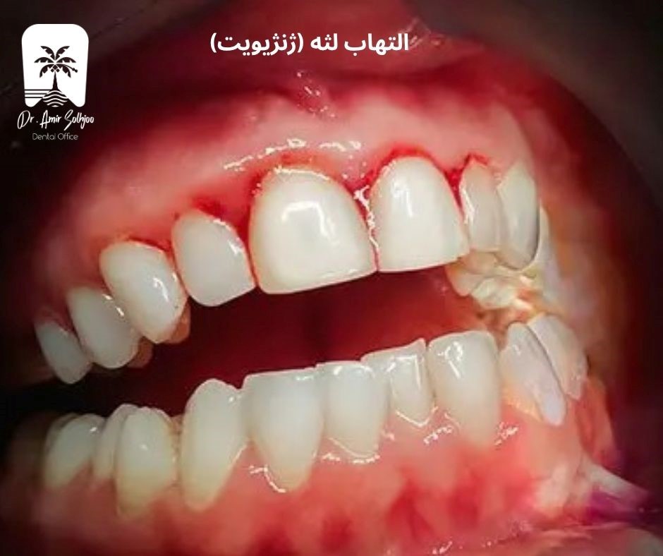 التهاب لثه