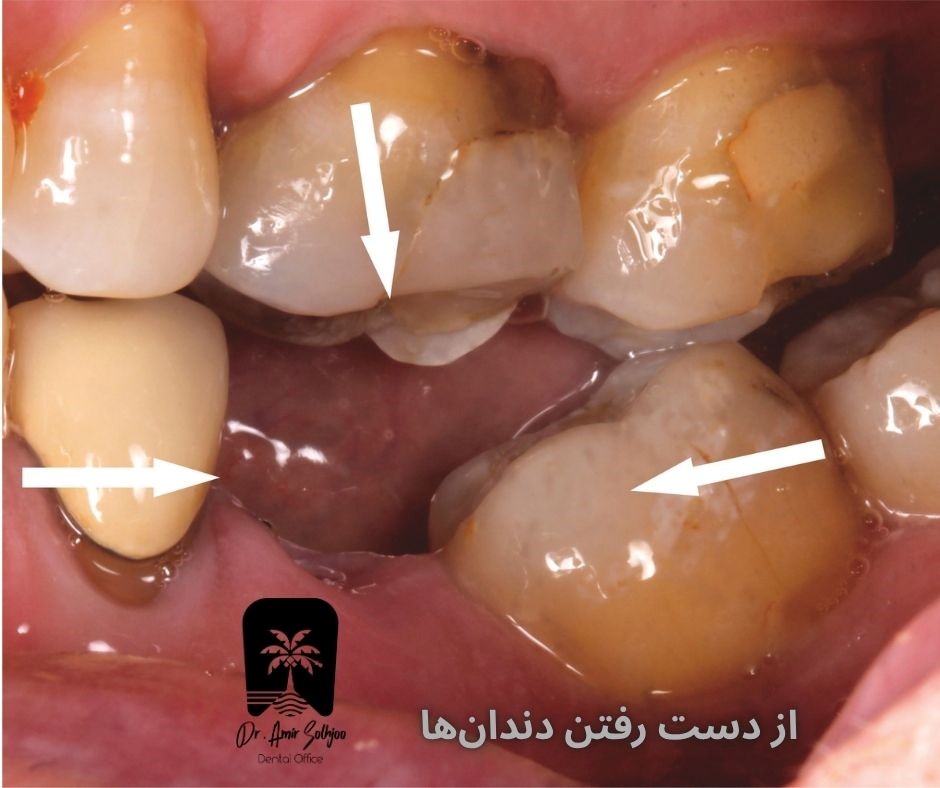 از دست رفتن دندانها