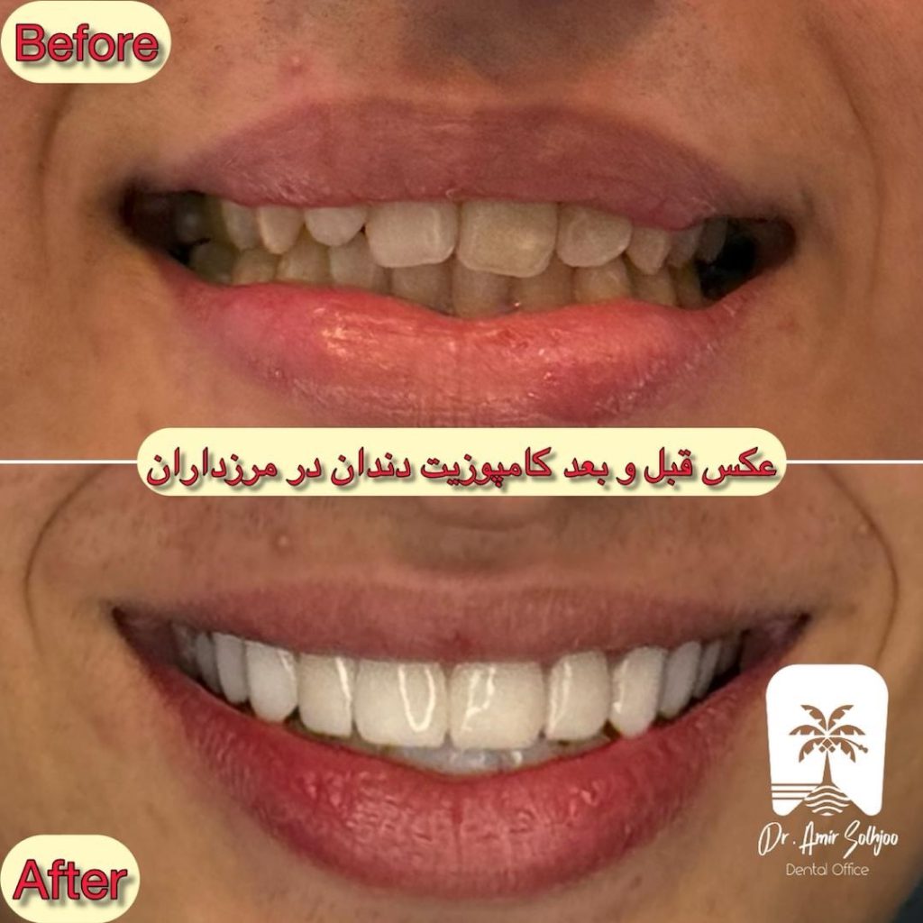 هزینه پر کردن دندان