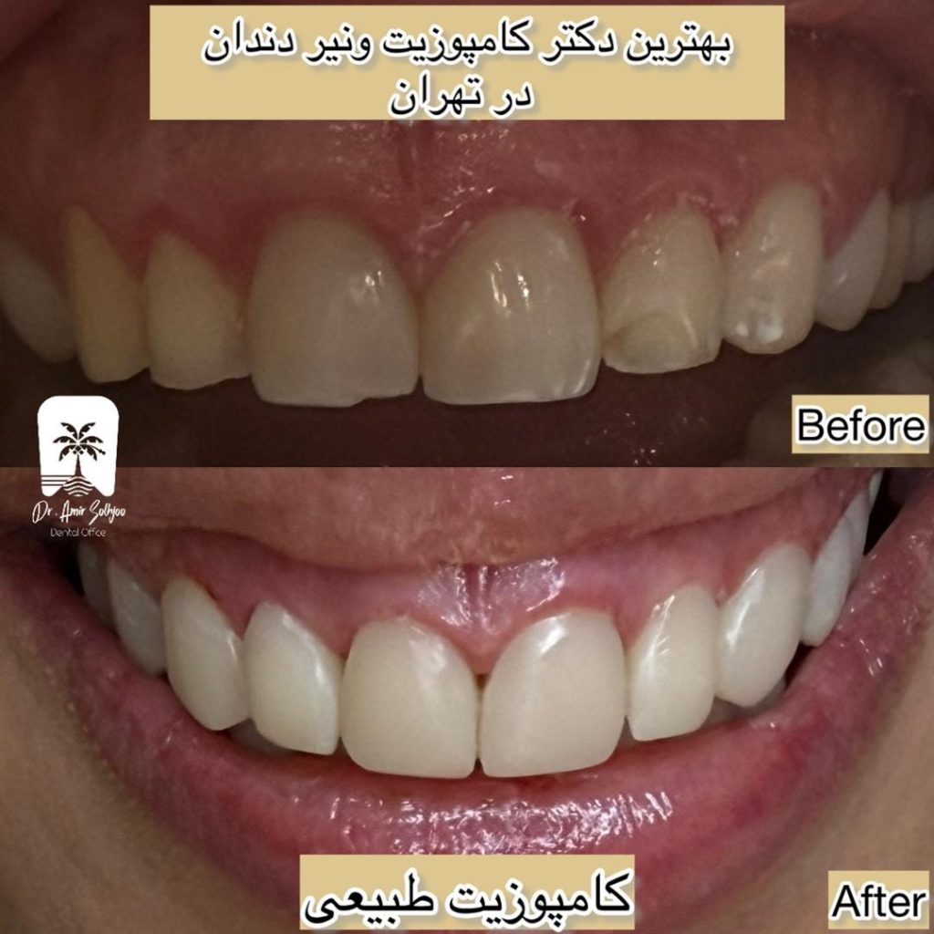 بهترین دکتر کامپوزیت تهران