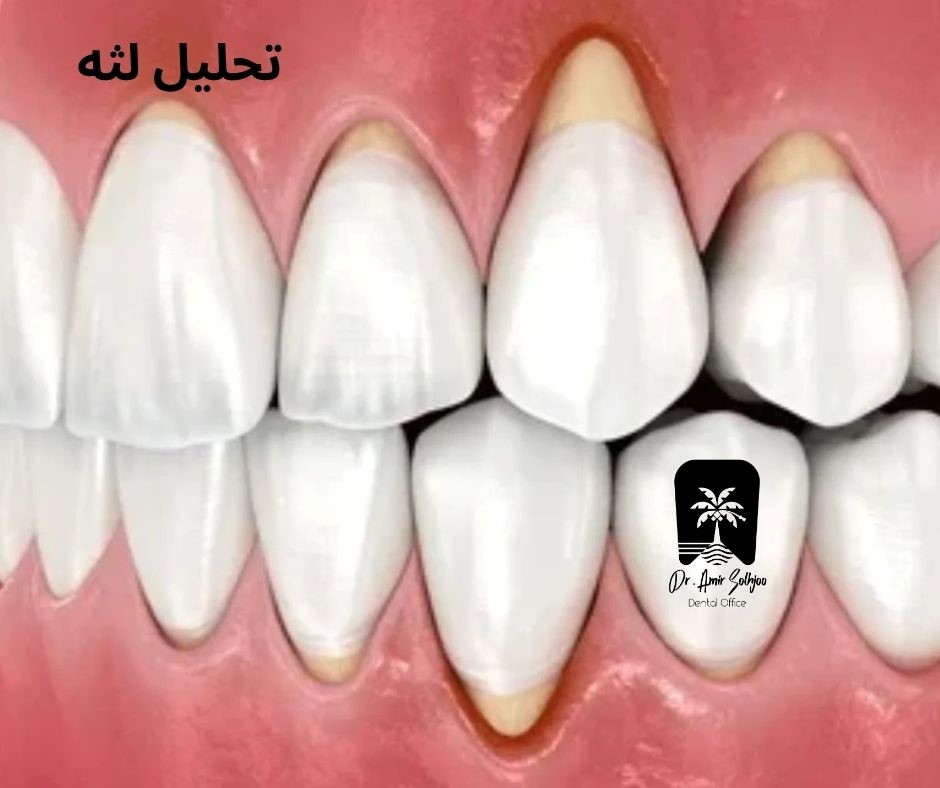 تحلیل لثه