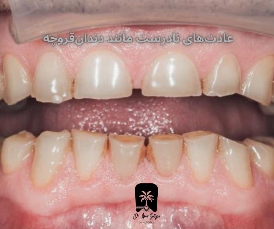عادتهای نادرست مانند دندانقروچه