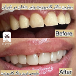 کامپوزیت دندان تهران