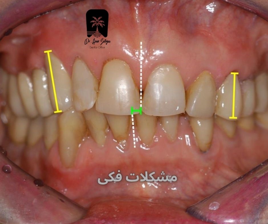 مشکلات فکی